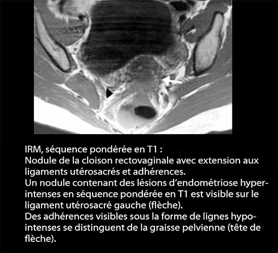 IRM endométriose — image IRM lésions endométriosiques pelviennes 9