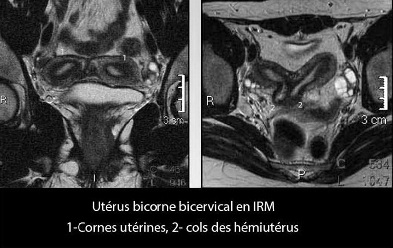 IRM_uterus bicorne