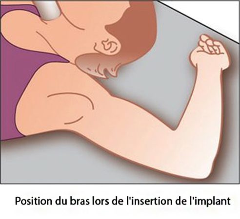Implant 1