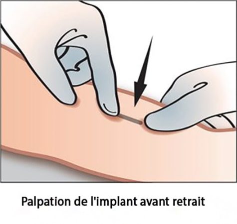 Implant contraceptif sous-cutané — pose et retrait Nexplanon 10