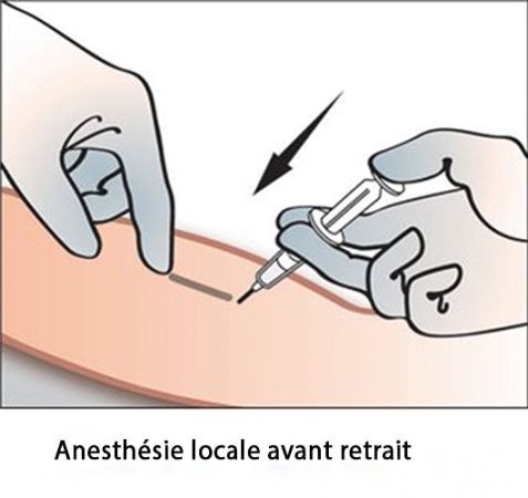 Implant contraceptif sous-cutané — pose et retrait Nexplanon 11