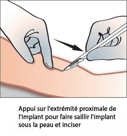 Implant contraceptif sous-cutané — pose et retrait Nexplanon 12