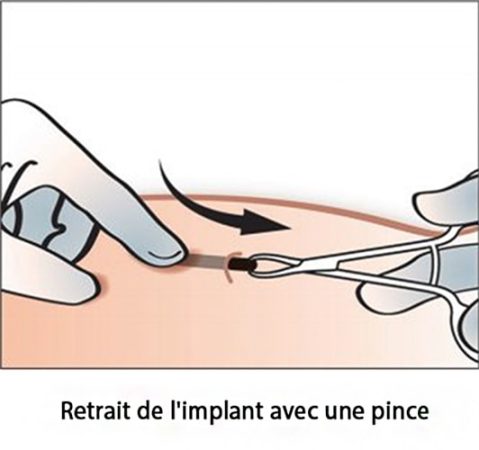 Implant contraceptif sous-cutané — pose et retrait Nexplanon 13