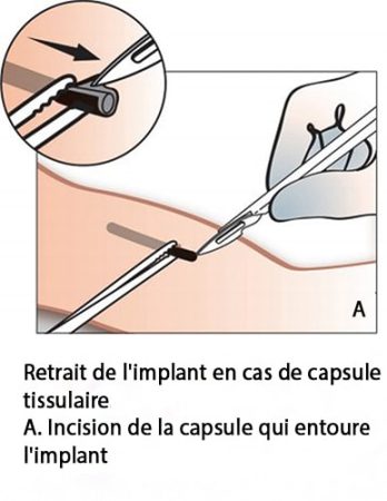 Implant contraceptif sous-cutané — pose et retrait Nexplanon 14