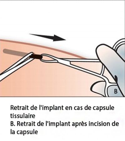 Implant contraceptif sous-cutané — pose et retrait Nexplanon 15