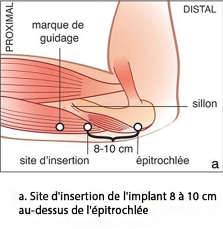 Implant contraceptif sous-cutané — pose et retrait Nexplanon 2