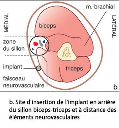 Implant contraceptif sous-cutané — pose et retrait Nexplanon 3