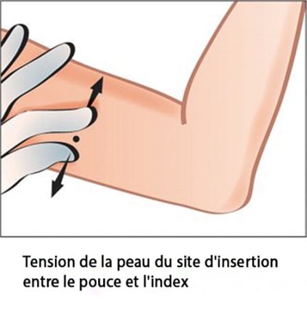 Implant contraceptif sous-cutané — pose et retrait Nexplanon 5