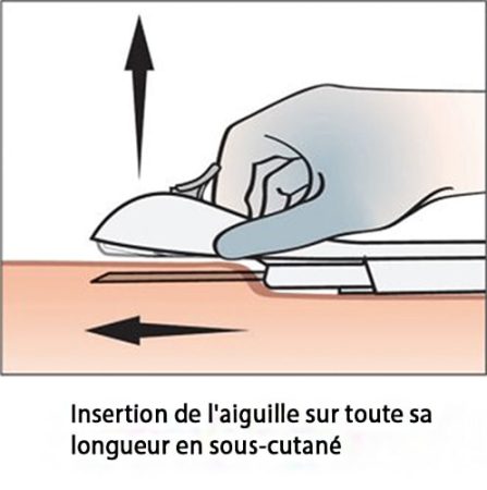 Implant contraceptif sous-cutané — pose et retrait Nexplanon 7