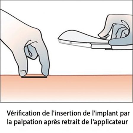 Implant contraceptif sous-cutané — pose et retrait Nexplanon 9