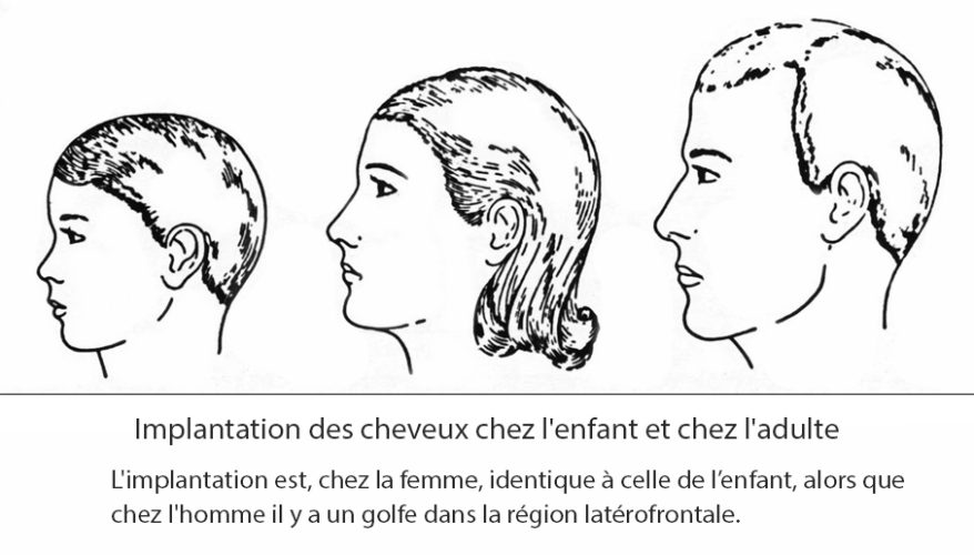 Implantation des cheveux