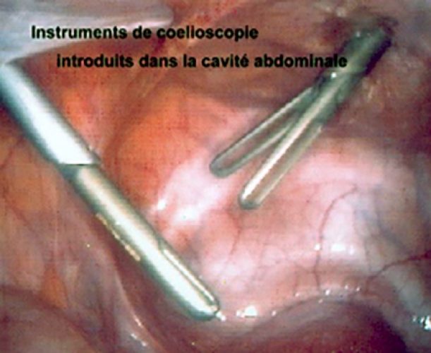 Instruments de coelio