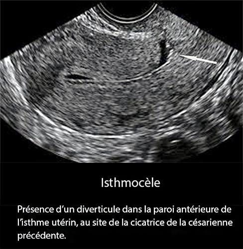 Isthmocèle