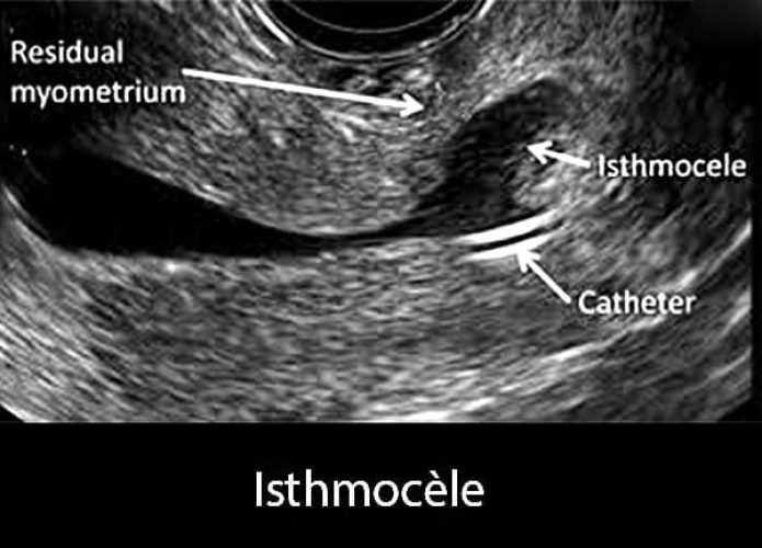 Isthmocèle