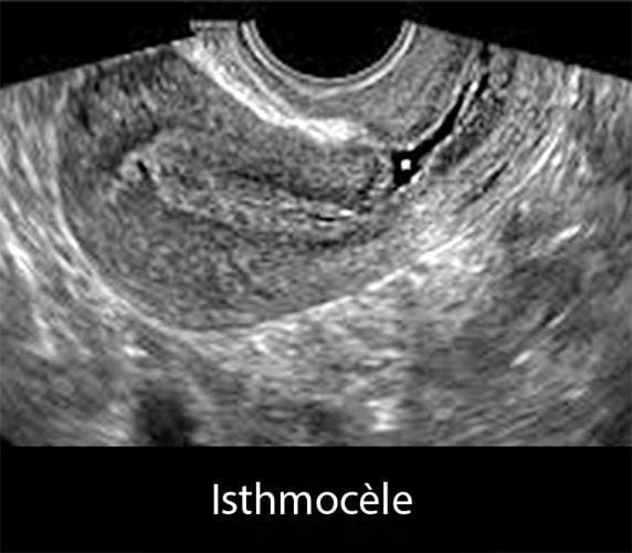 Isthmocèle