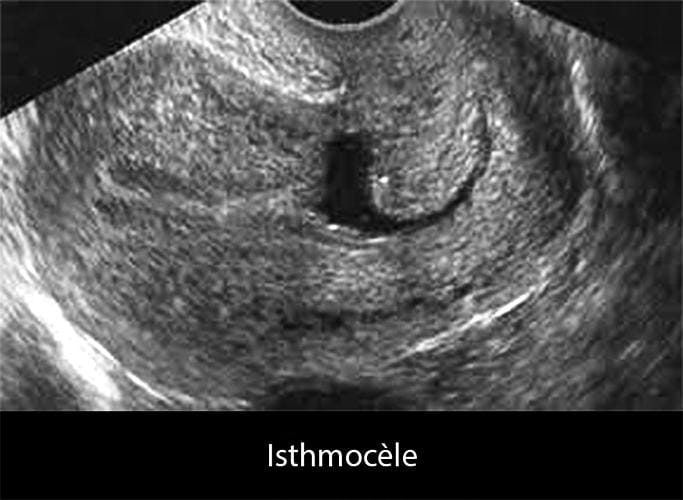 Isthmocèle