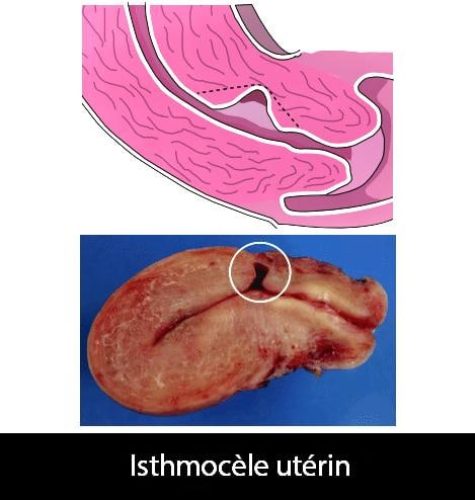 Isthmocèle