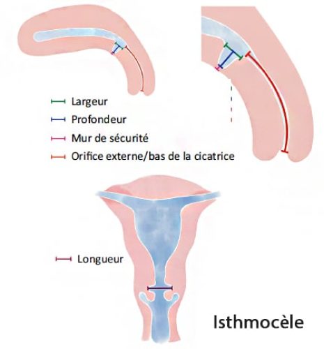 isthmocèle
