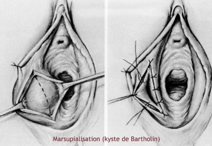 Marsupialisation des kystes et abcès des glandes de Bartholin