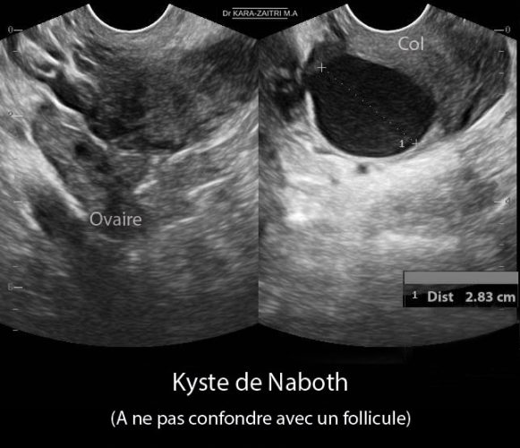 Kyste de Naboth 1