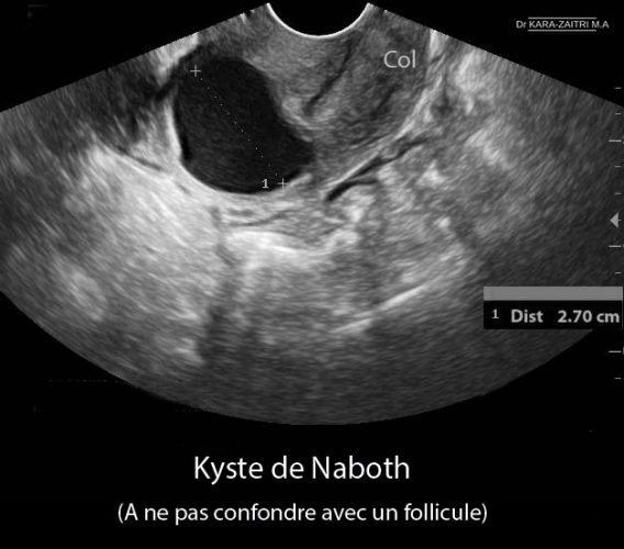 Kyste de Naboth 2