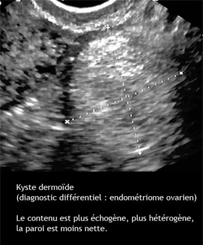 Kyste dermoide 1