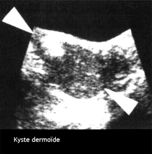 Kyste dermoide 2