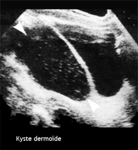 Kyste dermoide 3