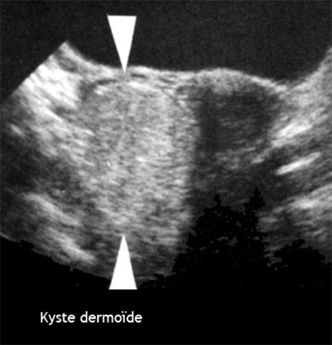 Kyste dermoide 4