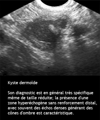 Kyste dermoide 5