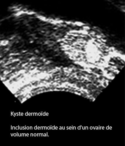 Kyste dermoide 6