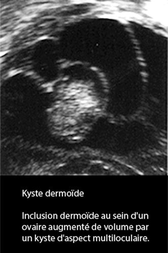 Kyste dermoide 7