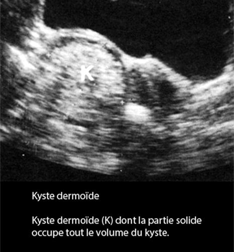 Kyste dermoide 8