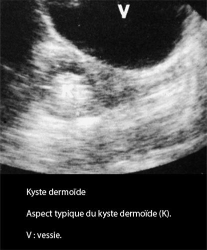 Kyste dermoide 9