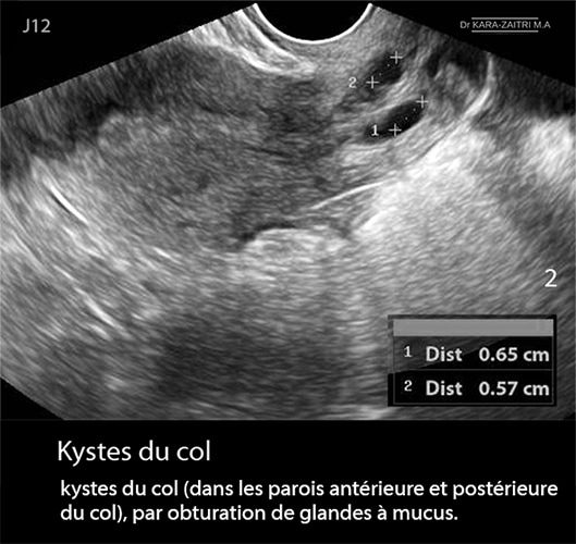Kyste du col 2
