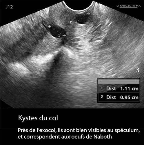 Kyste du col 3