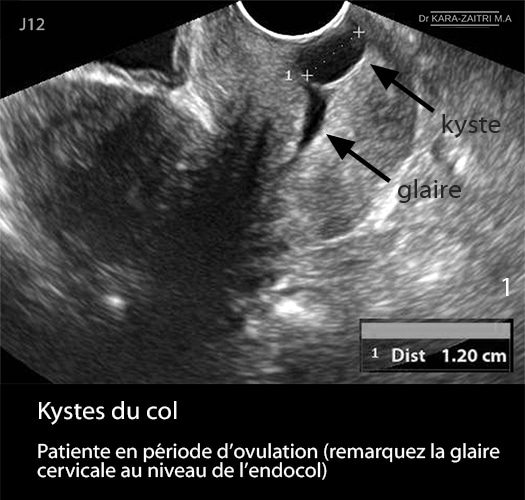 Kyste du col_glaire