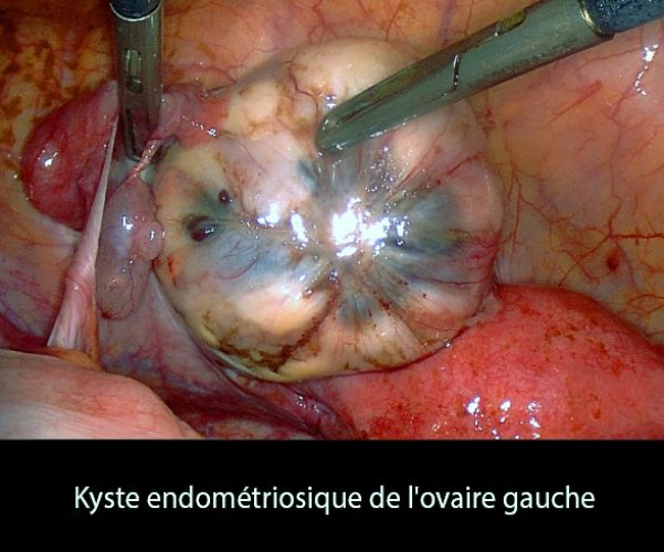 Kyste endométriosique ovaire