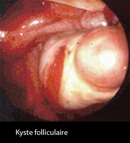 Kyste follicul 2_coelio
