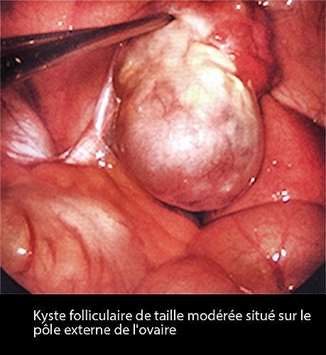 Kyste follicul_coelio