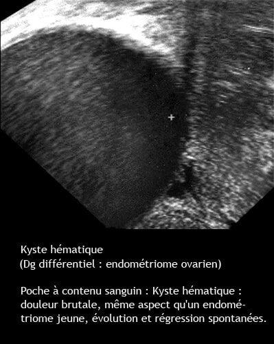 Kyste hématique ovarien — image échographique kyste hémorragique