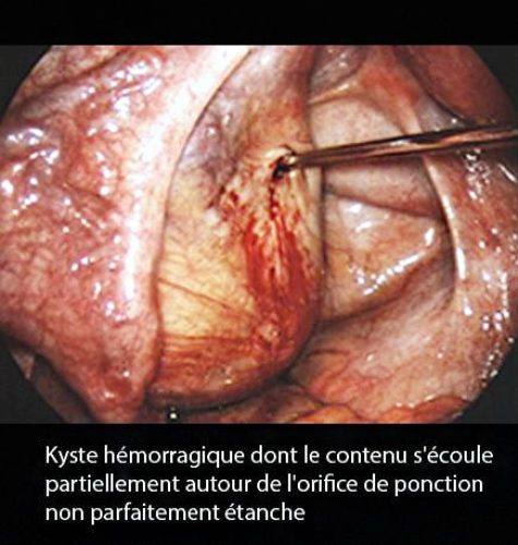 Kyste hémorragique_coelio