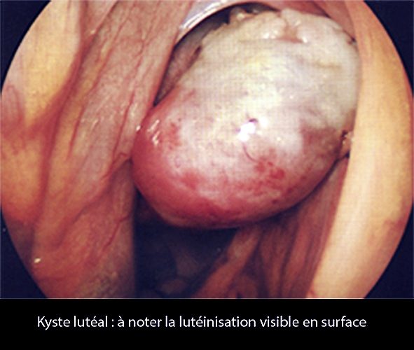 Kyste lutéal 1_coelio