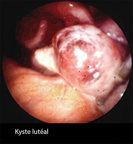 Kyste lutéal 2_coelio