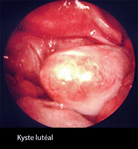Kyste lutéal 3_coelio