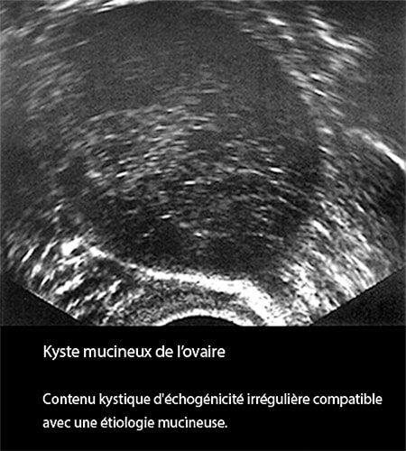 Kyste mucineux ovaire_écho