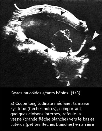Kyste ovarien mucoide 1