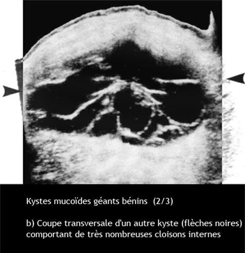 Kyste ovarien mucoide 2
