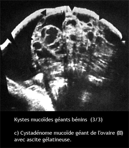 Kyste ovarien mucoide 3