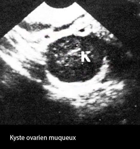 Kyste ovarien muqueux